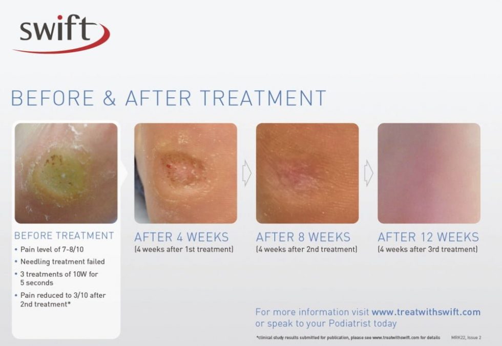 Swift Microwave Wart Treatment Adelaide Podiatry Centres