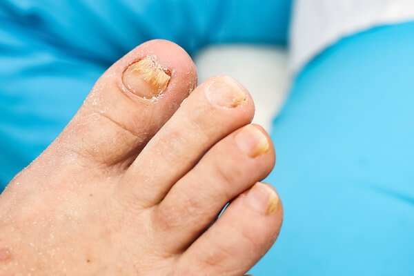 Fungal Nails St Peters