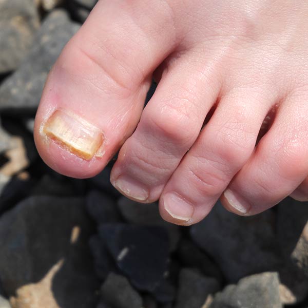 Fungal Nails St Georges