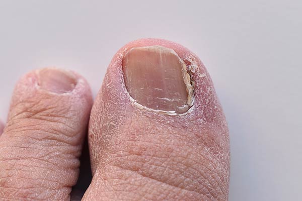 Symptoms of Fungal Nails St Georges