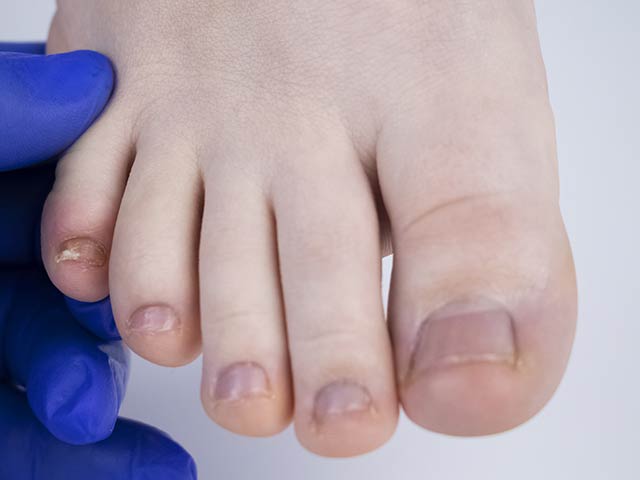 Fungal Nail Treatment St Georges
