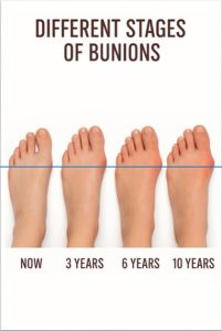 Stages of Bunions