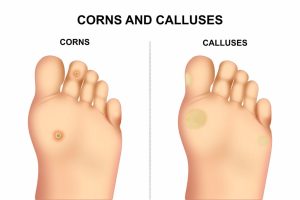 Corn and Callus treatment Adelaide
