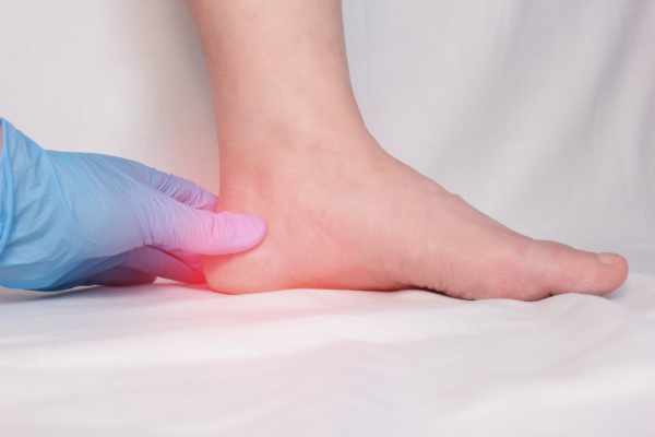 Heel Spur Treatment Adelaide