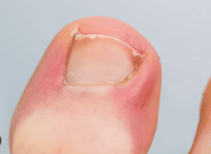 Ingrown Toenail